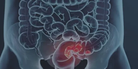 Câncer Colorretal: Brasil Projeta Aumento de 36% em Mortes Até 2040; Saiba os Sinais de Alerta